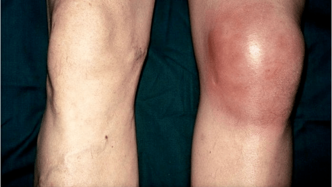 Arthrosis and arthritis
